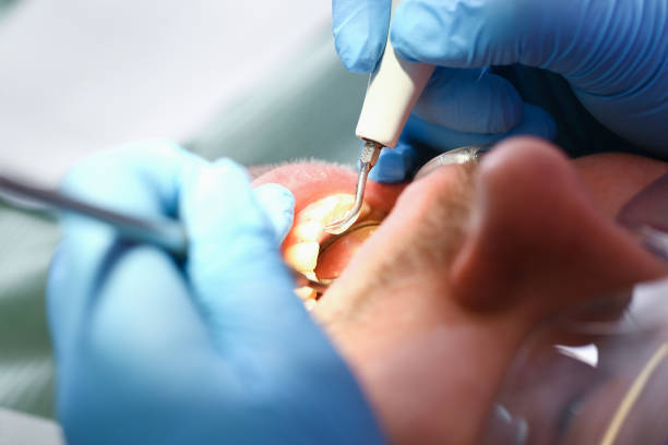 Best Emergency Wisdom Teeth Removal in Point Venture, TX